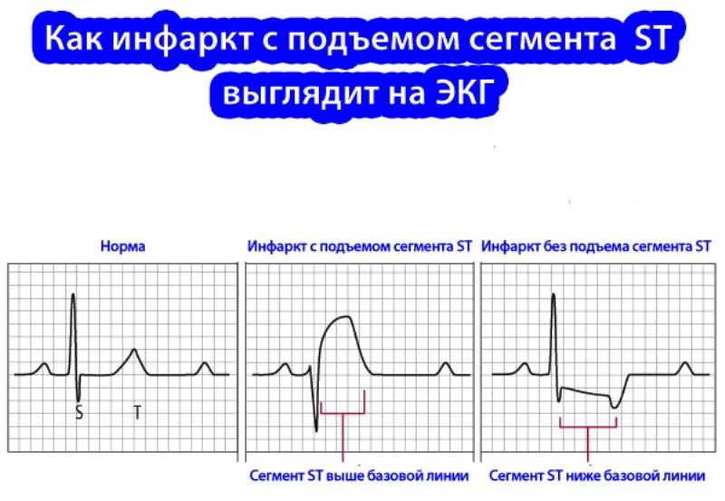 Экг подъем. Инфаркт с подъемом сегмента St ЭКГ. ЭКГ инфаркт миокарда без подъема St. ЭКГ при инфаркте миокарда без подъема сегмента St. Подъем сегмента St на ЭКГ.