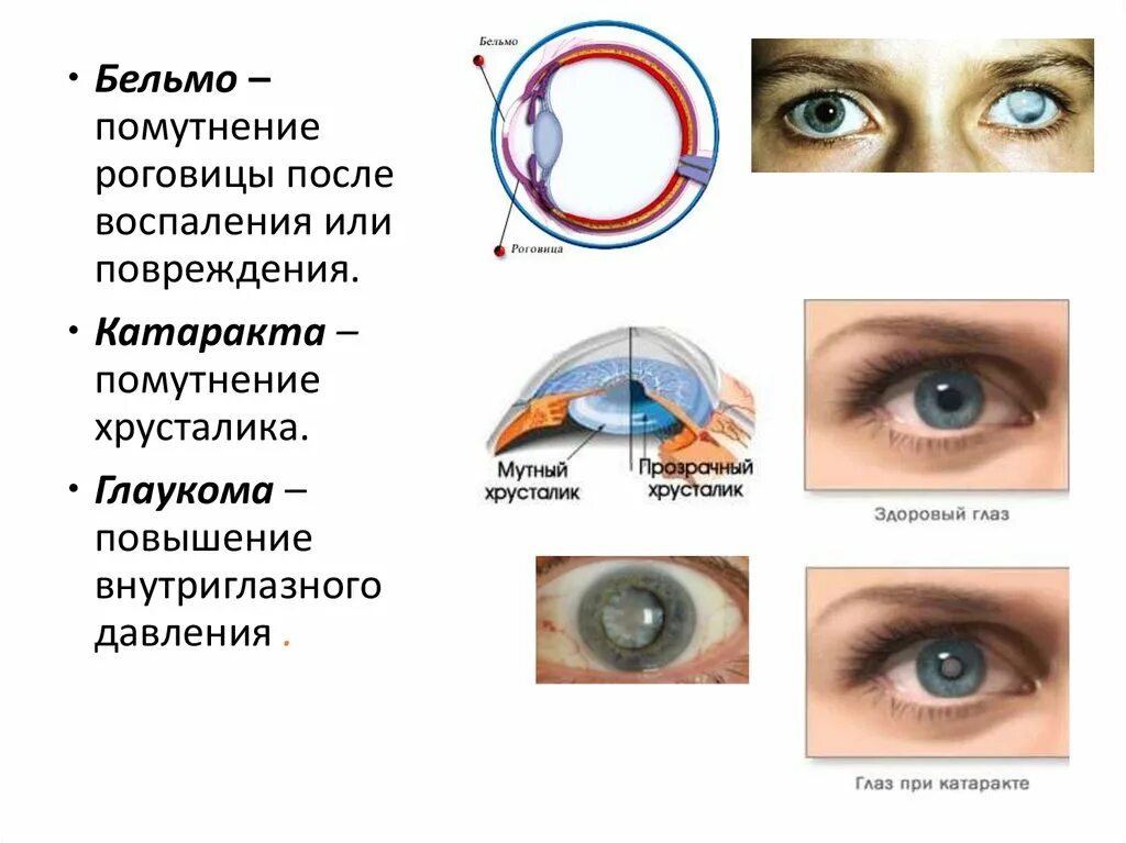 Когда после замены хрусталика восстанавливается зрение глаза. Помутнение роговицы и хрусталика. Мутнение кристалика глаз. Катаракта помутнение хрусталика.