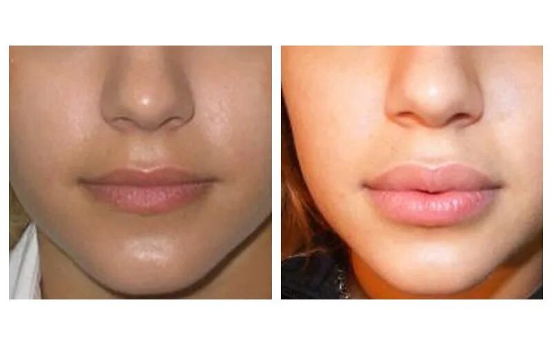 CARE’FULL CLINIC-Med.Estética on Instagram: "✨ Preenchimento lábio com Ácido Hia