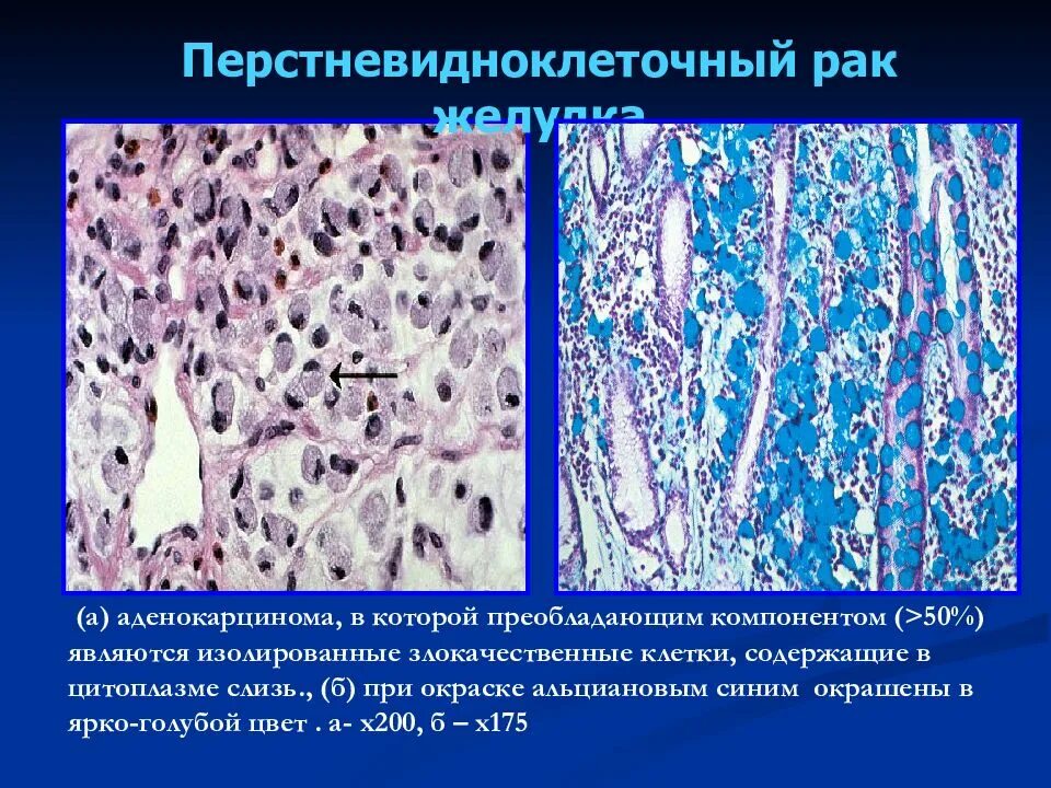 Перстневидноклеточный рак желудка