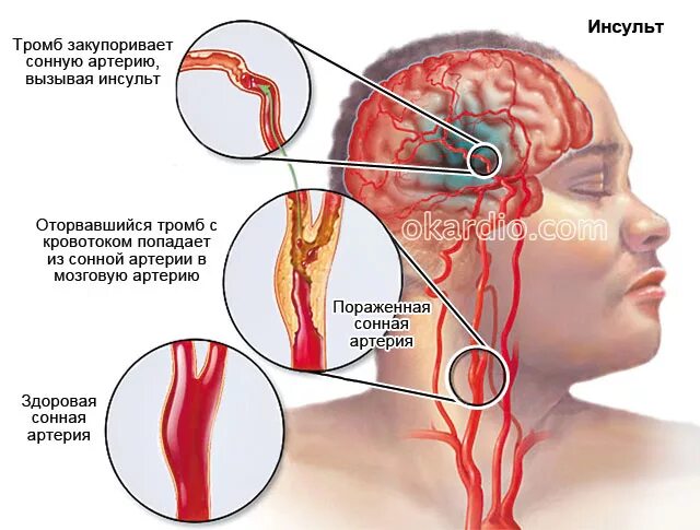 Микро ишемический инсульт. Тромбоз сонной артерии.