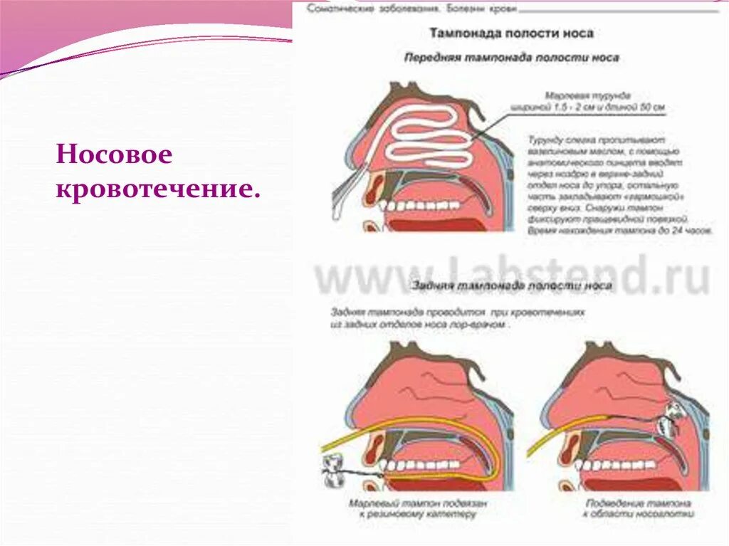 Часто идет носом кровь у взрослого причины. Причины носового кровотечения. Заднее кровотечение из носа. Передние и задние носовые кровотечения.