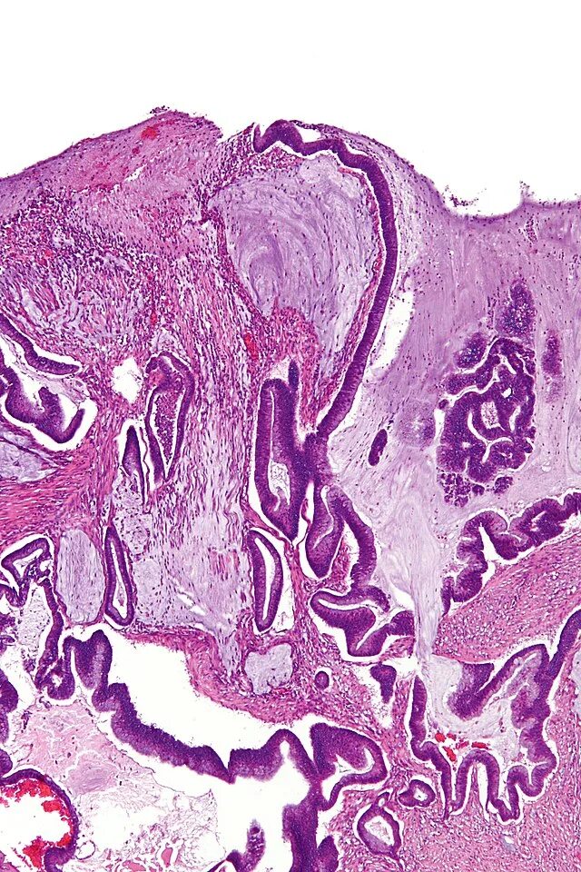 Metastatic Carcinoma in Liver Tissue at 10x Magnification Nikon’s MicroscopyU