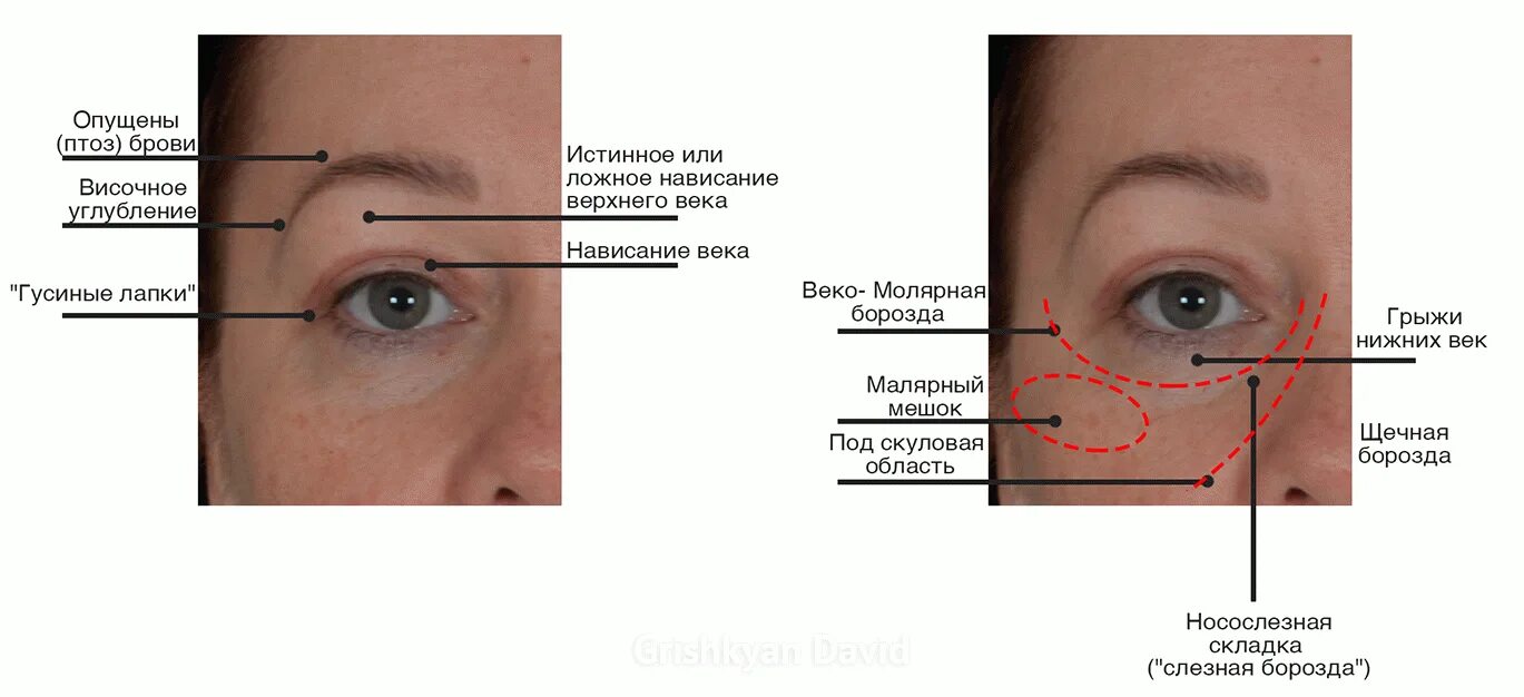 Малярный мешок слезная борозда. Веко верхнее птоз 1 степени. Птоз ( опущение верхнего века.