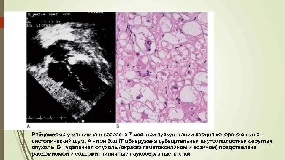 Рабдомиома сердца. Доброкачественные опухоли сердца.