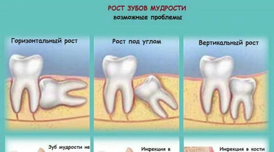 Удаление зуба мудрости снизу. Зуб восьмерка костная ткань. Зубы болят и сверху и снизу