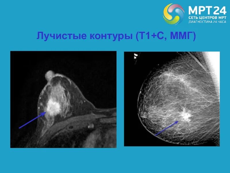 нечеткий неровный контур образования молочной железы. образование правой молочной железы. нечеткий неровный контур образования молочной железы. аваскулярное гипоэхогенное образование что это. филлоидная фиброаденома.