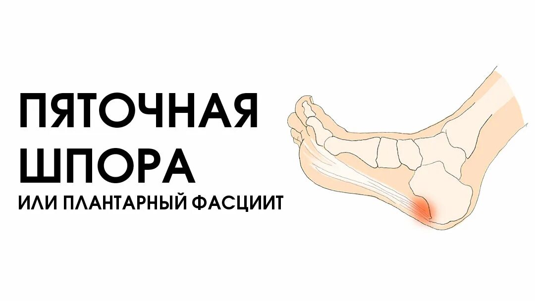 Шпоры причина появления. Плантарный фасциит пятки. Пяточная шпора плантарный фасциит. Пяточно подошвенный фасциит.