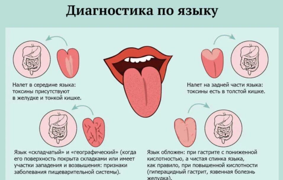Что означает розовый язык. Симптомы по цвету языка. Болезни по языку определить.