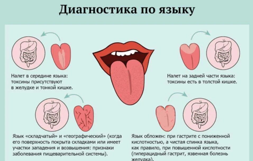 Язык по утрам причины. Заболевания по цвету языка. Болезни по языку схема. Белый налет на языке болезнь.