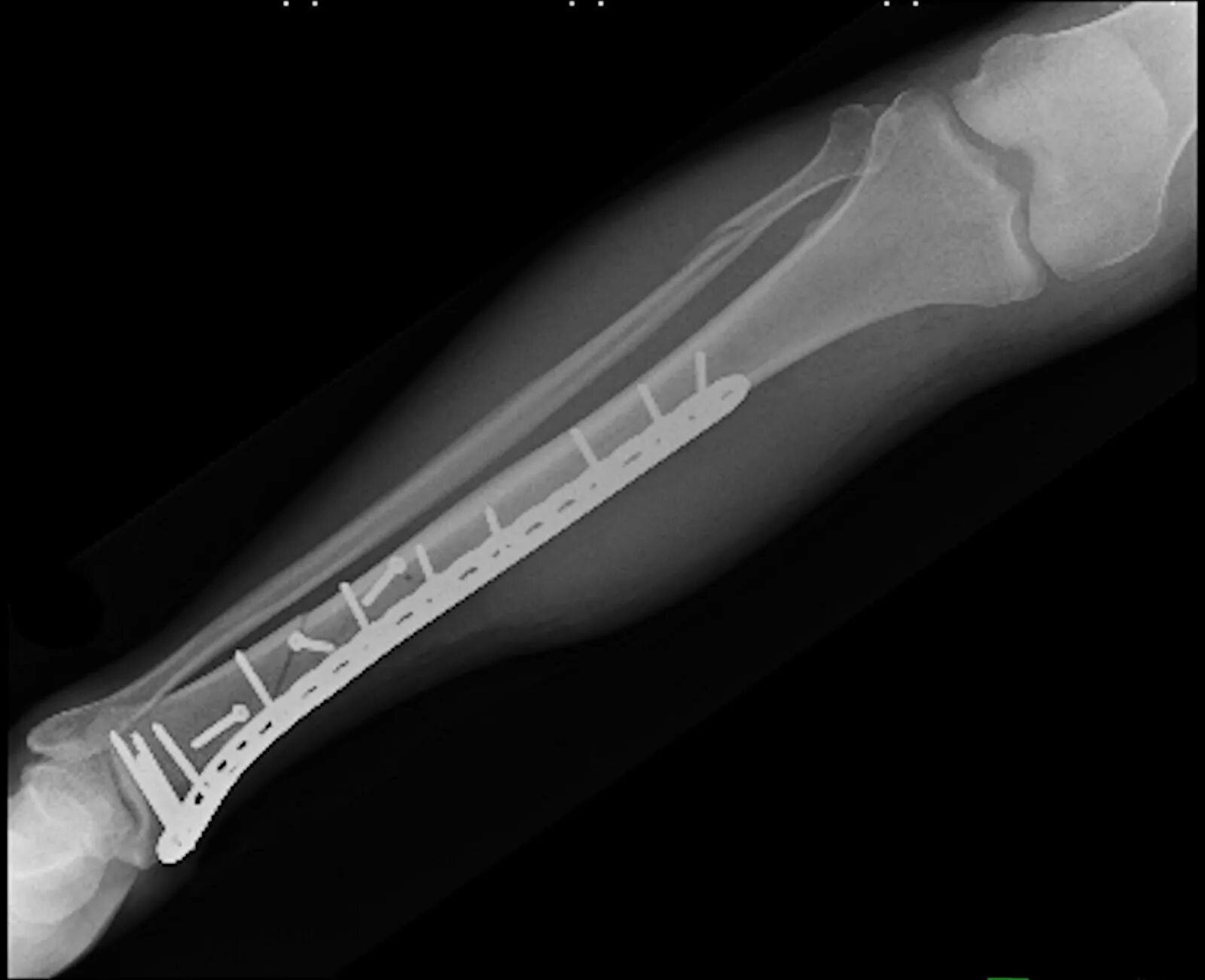 A fracture is a broken bone. Смешные переломы костей. anterioposterior unbroken in lateral broken bone case. какой инструмент используют для поломанный костей.