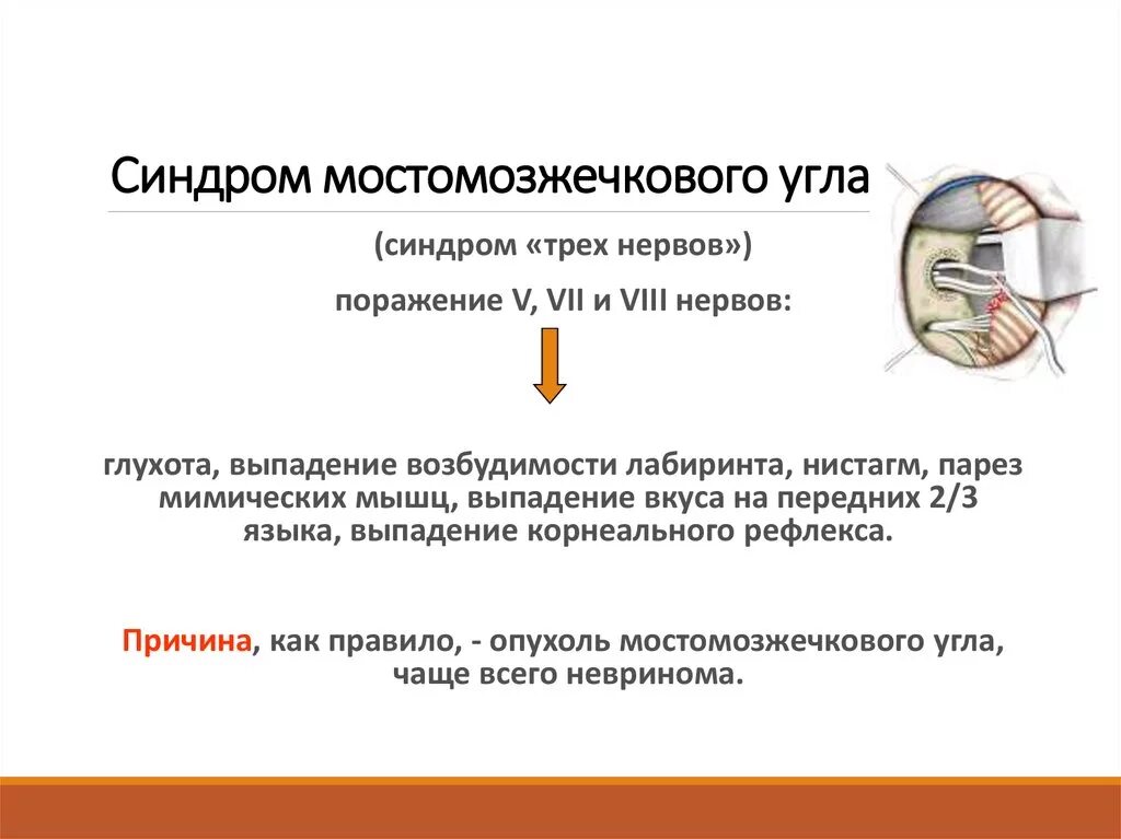 Синдром поражения структур мосто-мозжечкового угла.. Мосто-мозжечковый угол симптомы поражения. Симптомы поражения мостомозжечкового угла. Синдром мостомозжечкового угла симптомы. Мозжечковая опухоль