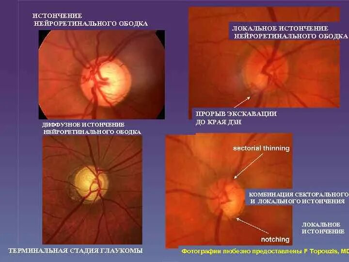 Зрительный нерв при глаукоме. Экскавация диска зрительного нерва окт. Глаукомная экскавация диска зрительного нерва. Физиологическая экскавация ДЗН.