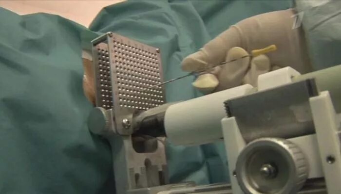 Брахитерапия рака предстательной. Низкодозная брахитерапия. контактная лучевая терапия брахитерапия это. брахитерапия (внутритканевая лучевая терапия). брахитерапия базалиомы.