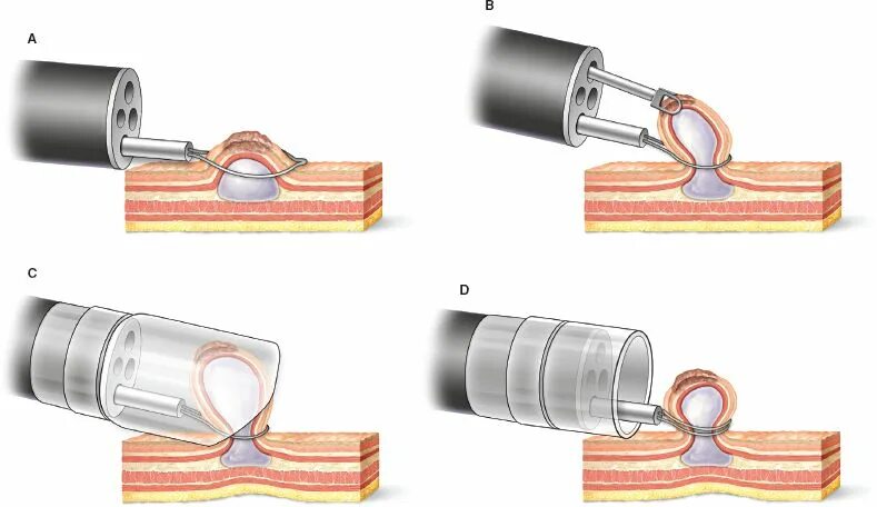 Эндоскопическая резекция слизистой emr. Эндоскопическая резекция слизистой emr. Диссекция в подслизистом слое. Подслизистая диссекция. Эндоскопическая подслизистая диссекция.