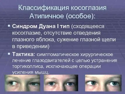 Как лечить косоглазие