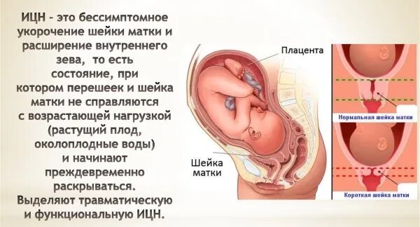 При беременности ощущается матка. Беременность матка в тонусе. Тонус матки при беременности. Гипертонус шейки матки.