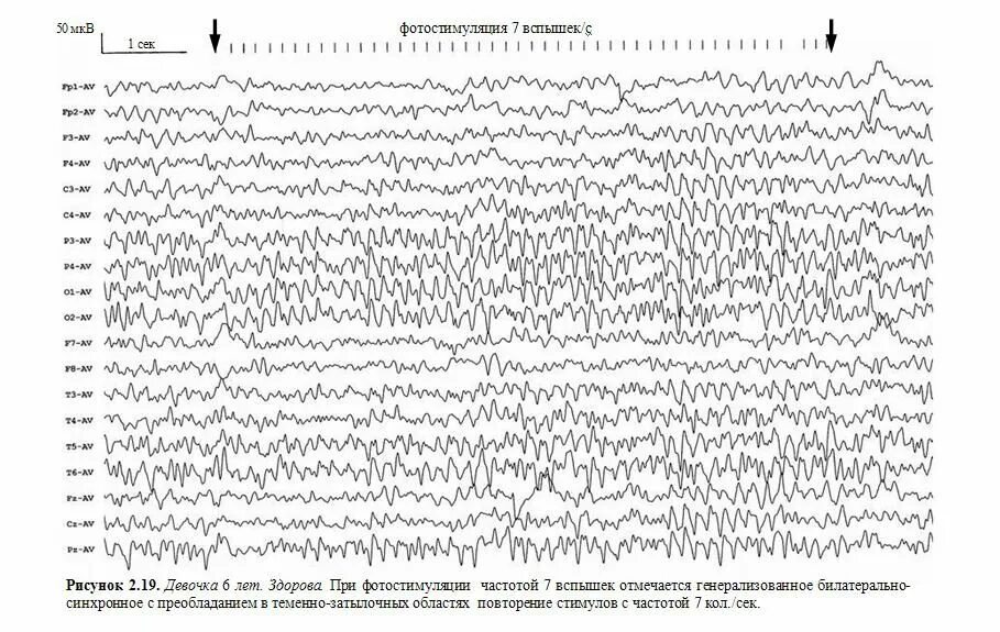 Нормы ээг у детей. Нормы фотостимуляции при ЭЭГ. ЭЭГ нормальные показатели у ребёнка 7 лет. Усвоение ритма фотостимуляции на ЭЭГ. Норма ЭЭГ У детей 7 лет.