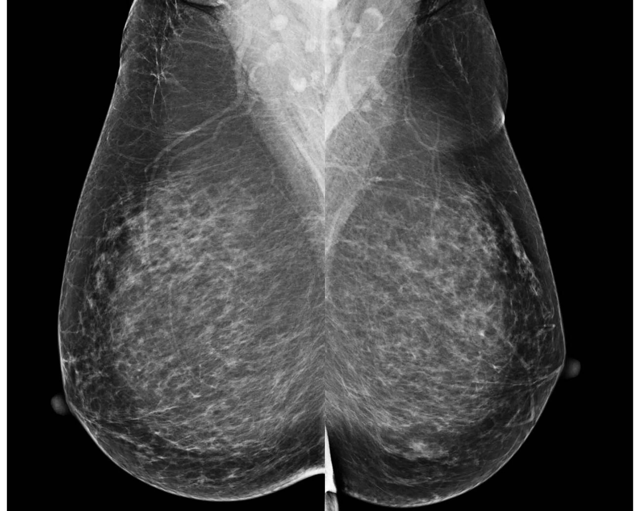 Билатеральная маммография. Маммография молочных желез acr 3 birads 1. Маммография 2 тип. Фиброзно-кистозная мастопатия bi-rads 2. Маммография молочных желез acr тип 3 birads 2.