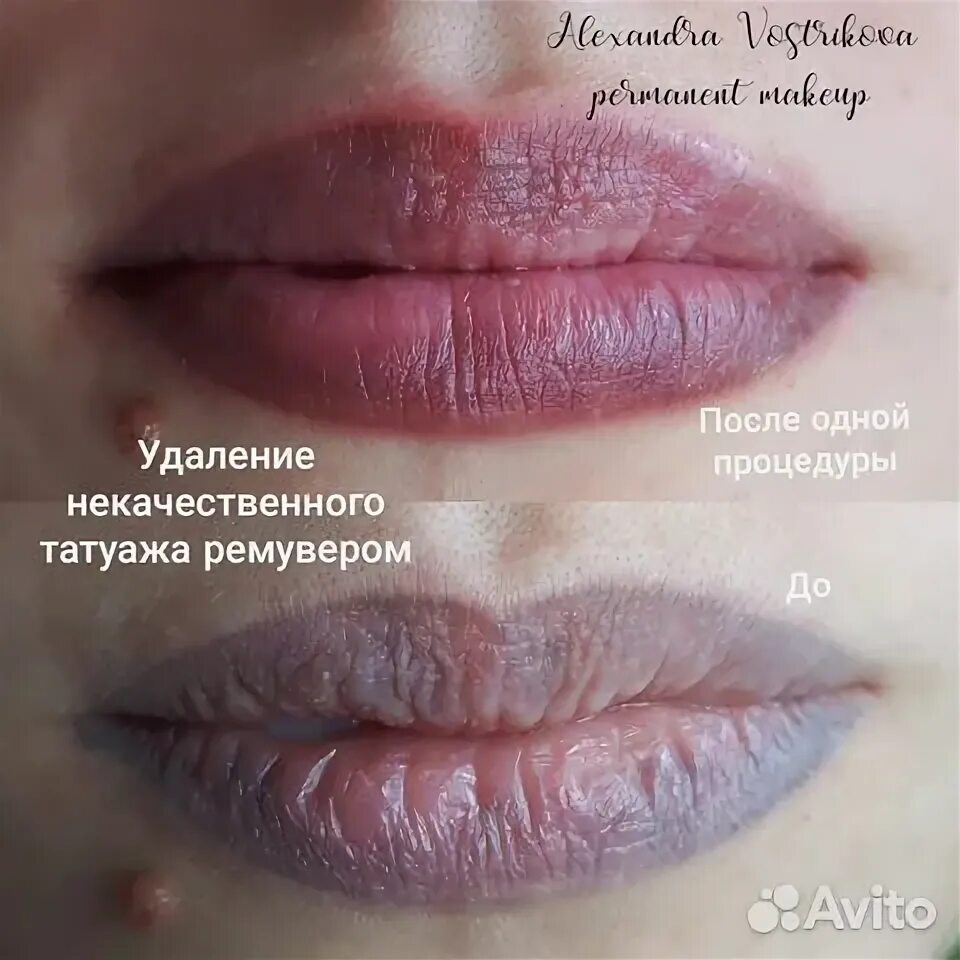 Удаление татуажа губ ремувером до и после Губы Махачкала. Услуги, Цены, Объявления на СтранаУслуг.ру как Авито