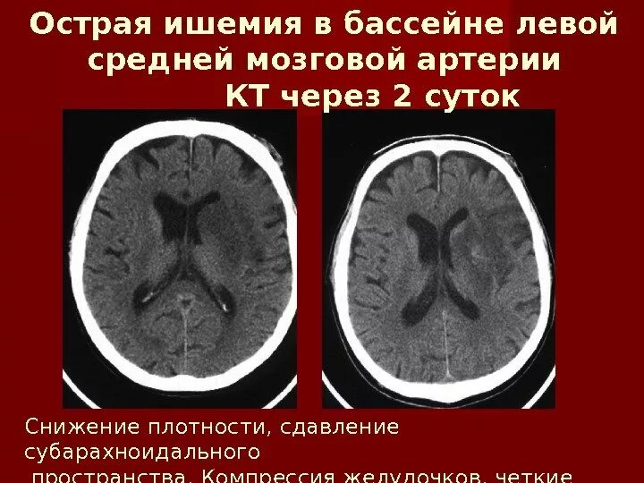 Инсульт правого бассейна. Ишемический инсульт кт. Ишемический инсульт в бассейне левой средней мозговой артерии. ОНМК В бассейне левой средней мозговой. Ишемический инсульт левой средней мозговой артерии поражения.