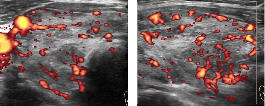 Перинодулярный кровоток что это. Что такое фрагментарный кровоток. Усиление кровотока ультразвуком. Кровотока диффузно усилен. Кровоток Пылающий а щит железе.