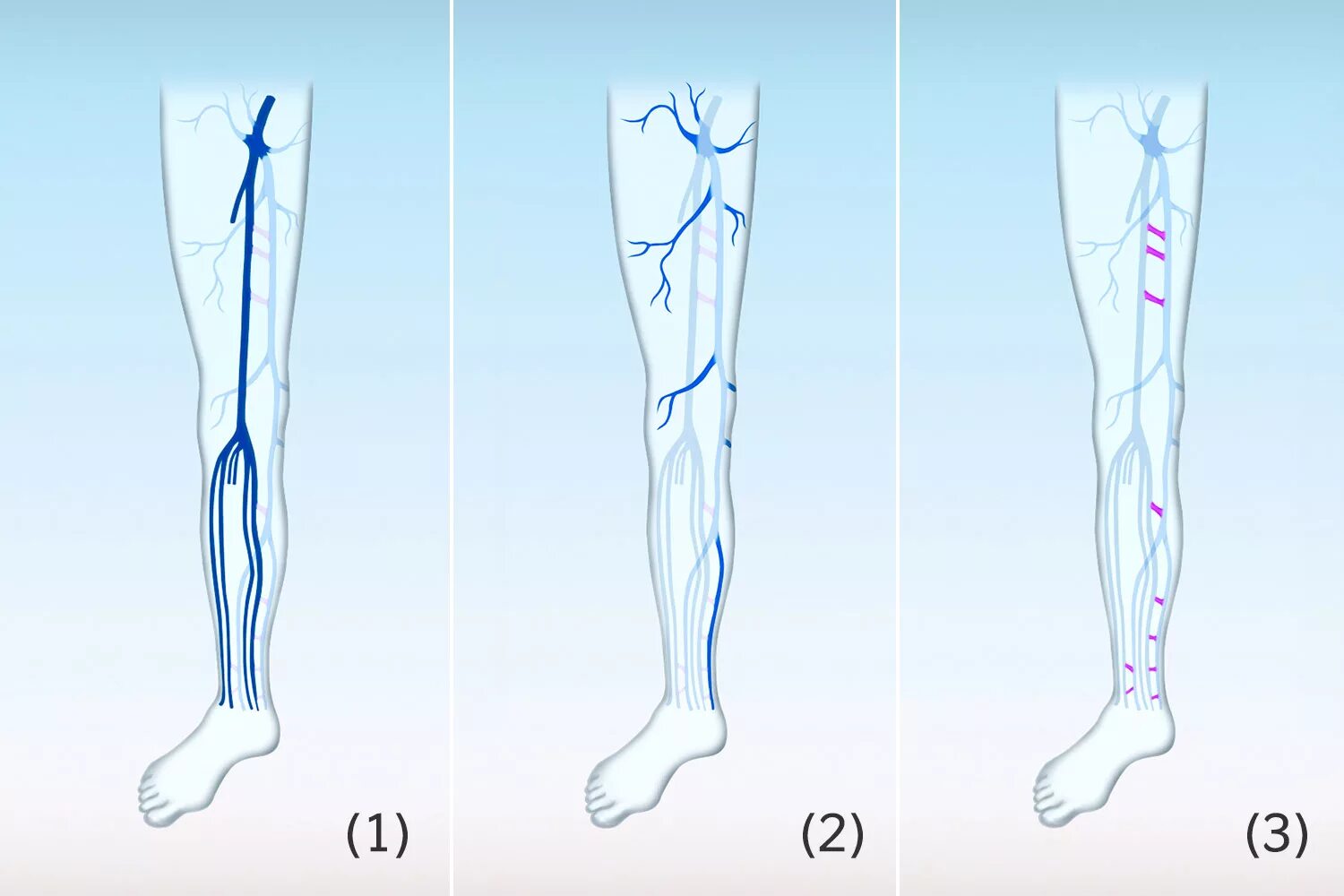 Карта вен нижних конечностей. Перфорантные вены нижних конечностей анатомия. Подкожные вены голени анатомия. Перфорантные вены голени.