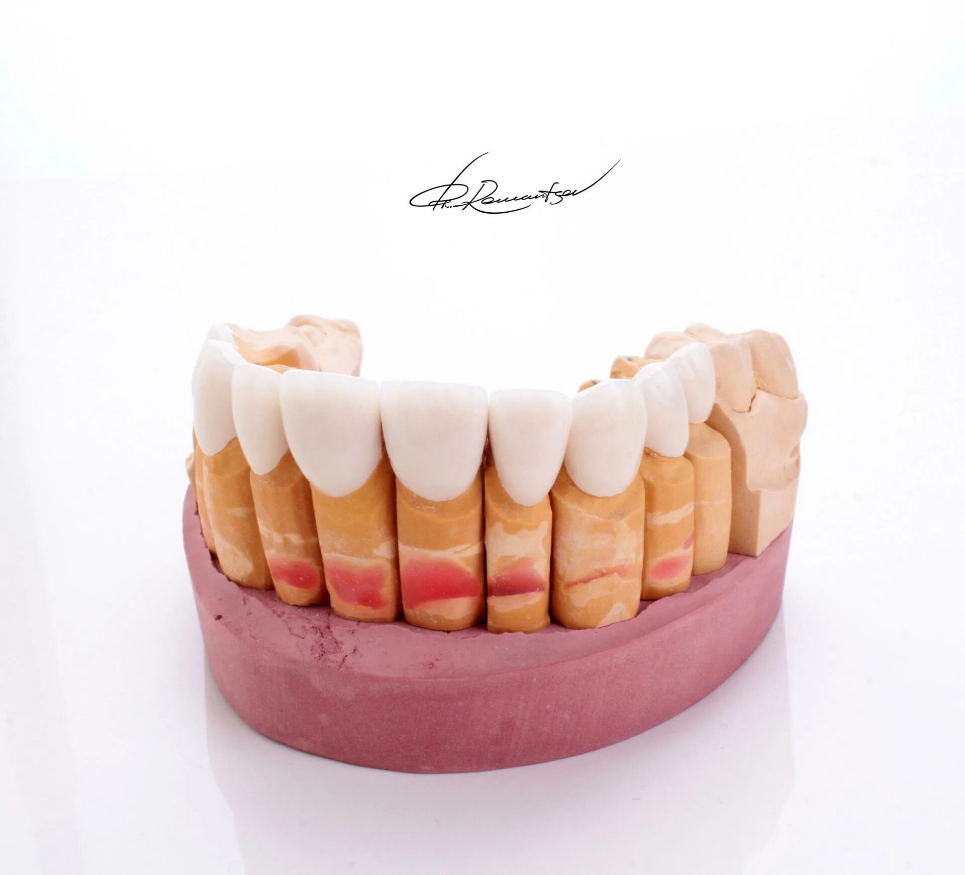 Зубы вестов. West dental clinic. кайни вест зубы. керамика на зубы которая закаливается при 280 градусах.