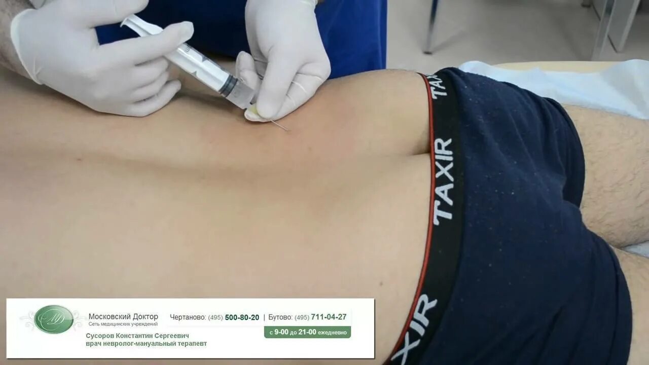 Блокада грыжи поясничного крестцового отдела позвоночника. Блокада межпозвонкового диска и грыжи. эпидуральная блокада при грыже позвоночника. препараты для блокады позвоночника при грыже. паравертебральная блокада позвоночника.