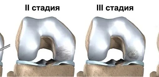 Асептический некроз мыщелка бедренной. Болезнь Кёнига рассекающий остеохондрит. Болезнь Кенига коленного сустава кт. Хондромаляция бедренной кости. Хондромаляция коленного сустава что это.