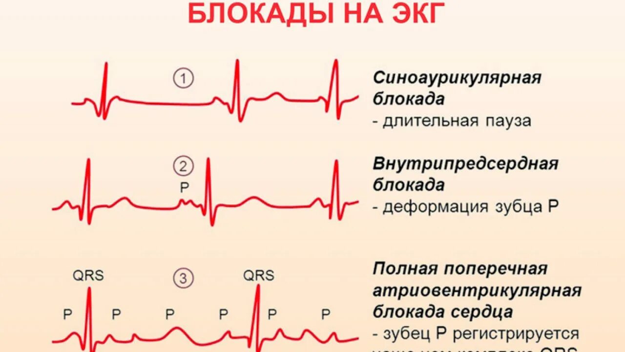 Что значит внутрипредсердная внутрипредсердная блокада. Внутрипредсердная блокада на ЭКГ. Блокады на ЭКГ. Блокады сердца на ЭКГ. Внутрипредсердные блокады на ЭКГ.