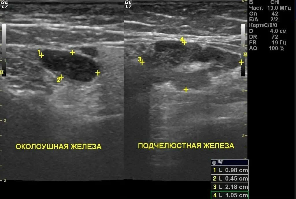 Паротит (воспаление околоушных желез). Лимфаденит УЗИ лимфоузлов. Гнойный лимфаденит на УЗИ. Увеличен лимфоузел в молочной железе