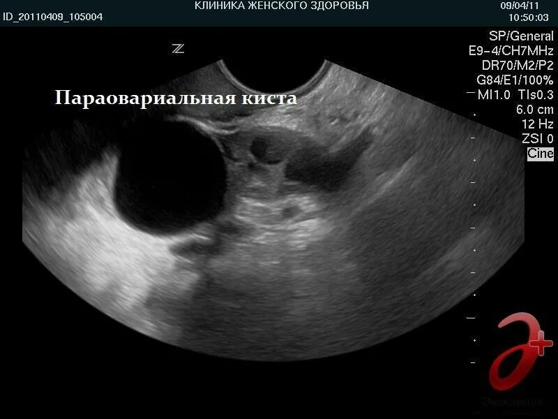 Как выглядит яичник. Параовариальная киста на узи яичника. ретенционная киста яичника на узи. параовариальная киста перекрут. фолликулярная киста яичника.