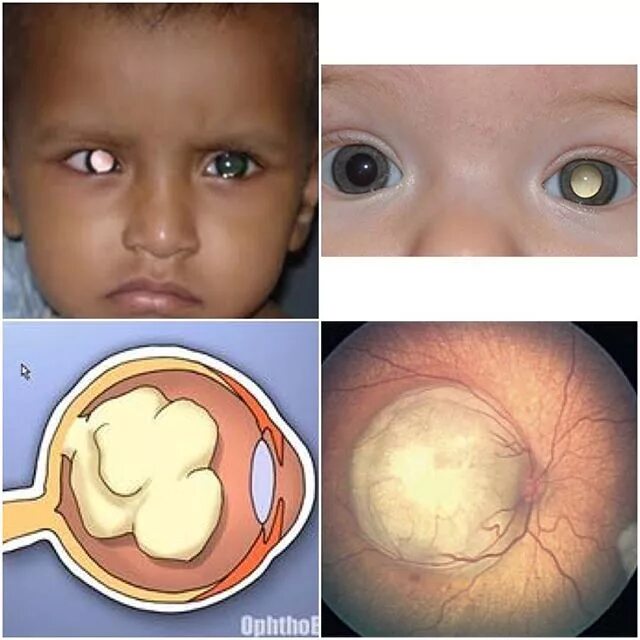 Врожденные опухоли. Ретинобластома сетчатки глаза. Орбитальная ретинобластома. Ретинобластома 2 стадия. Бинокулярная ретинобластома.