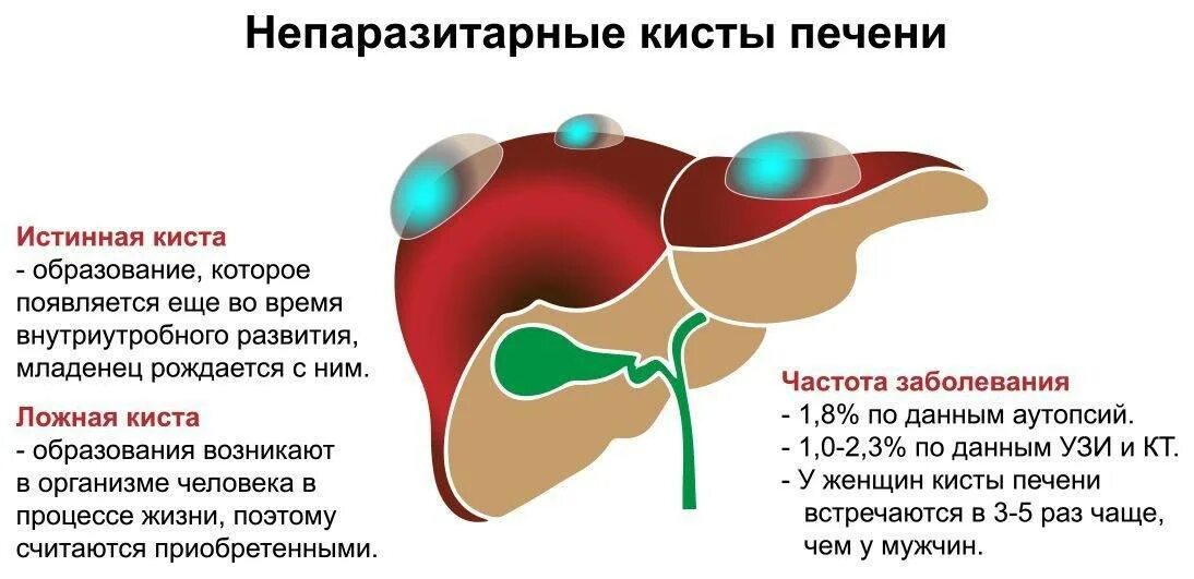 Киста левой доли печени 14 мм. Кистозные образования печени. Ретенционные кисты печени это. Непаразитарные кисты печени. Печень ощущается