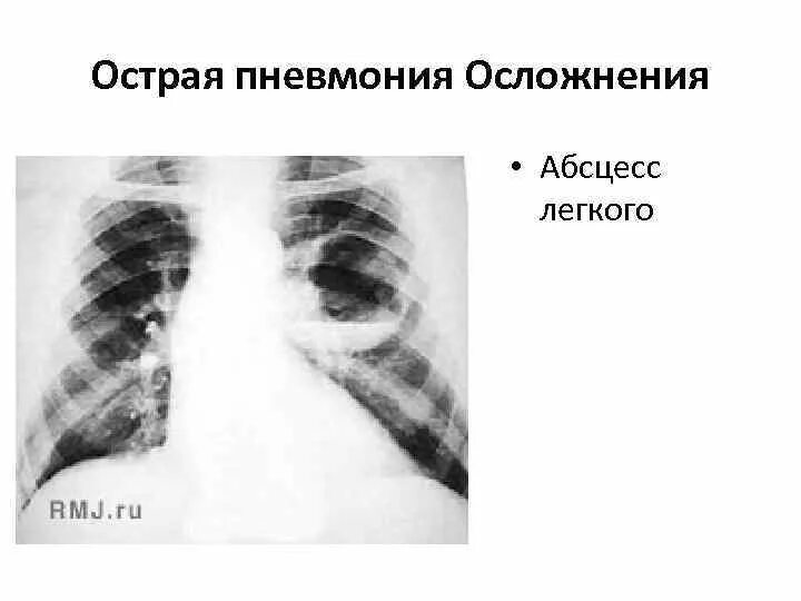 Пневмониогенный абсцесс легкого. Осложнение пневмонии абсцесс легкого. Пневмония с абсцессом легкого. Рентгенодиагностика абсцесса легкого. Пневмония легких осложнения