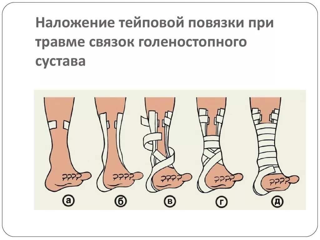 Какая повязка при повреждении голеностопного сустава. Растяжение связок голеностопного сустава перевязка. Наложение повязки при повреждении связок голеностопа. Наложение повязки на голеностопный сустав при растяжении связок. Наложите повязку при травме голеностопного сустава.