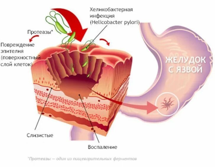 Язвенная болезнь желудка и двенадцатиперстной кишки. Язва желудка и 12 перстной кишки. Патогенез язвы желудка и двенадцатиперстной кишки. Осложнения желудка 12 перстной кишки