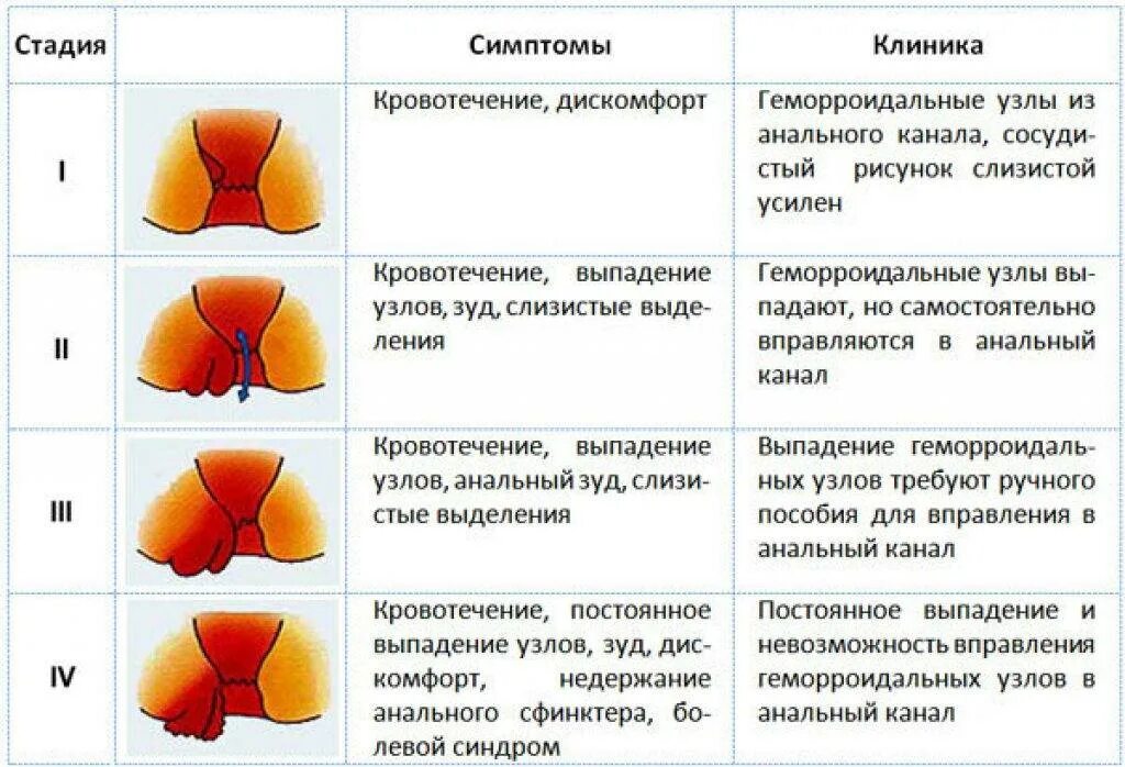 Сфинктерит прямой кишки симптомы