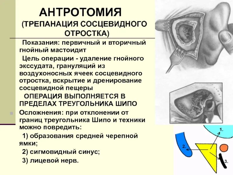 Склерозирование сосцевидного отростка. Пневматический Тип сосцевидного отростка. Слизистая ячеек сосцевидного отростка. Воспаление ячеек сосцевидного отростка. Утолщение слизистой сосцевидного отростка