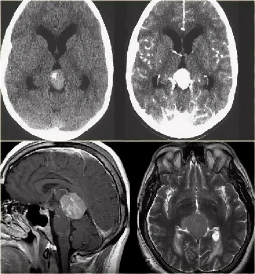 Герминома. Обызвествление шишковидной железы мрт. Обызвествление шишковидной железы на кт. Глиома головного мозга кт.