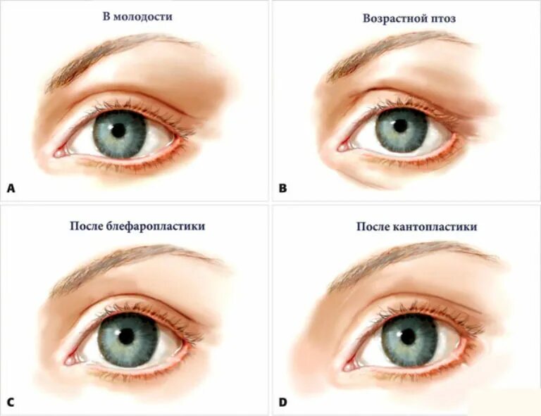 Кантопластика и кантопексия. Медиальная кантопластика внутреннего угла глаза. Кантопексия/кантопластика нижних век. Кантопластика внешнего уголка глаза. Почему увеличивается глаза