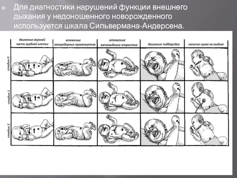 Шкала сильвермана. Шкала Сильвермана Андерсена для новорожденных. Баллард шкала для новорожденных недоношенных. Шкала Сильвермана для недоношенных. Шкала Сильвермана для новорожденных недоношенных.