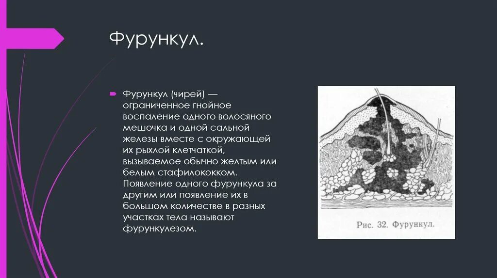 Гнойное воспаление волосяного мешочка. Гнойно-некротическое воспаление волосяного мешочка - это. Описание гнойного