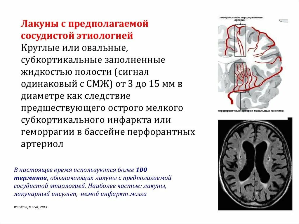 Дисциркуляторная энцефалопатия этиология. Субкортикальное кровоизлияние. Внутримозговое кровоизлияние в полушарие субкортикальное.