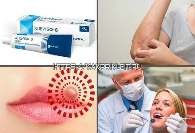 Аптечный клей бф-6 для ран. Клей для ран бф-6. Медицинский клей для порезов кожи. Клей бф на открытую рану можно. Клей бф на открытую рану можно.