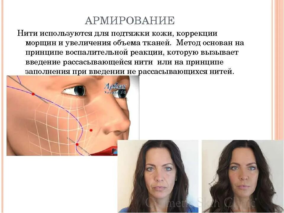 Нити для лица какие лучше. Армирование овала лица нитями. Золотое армирование лица.