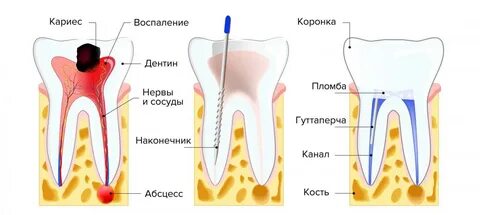 Последствия, если вовремя не вылечить кариес 