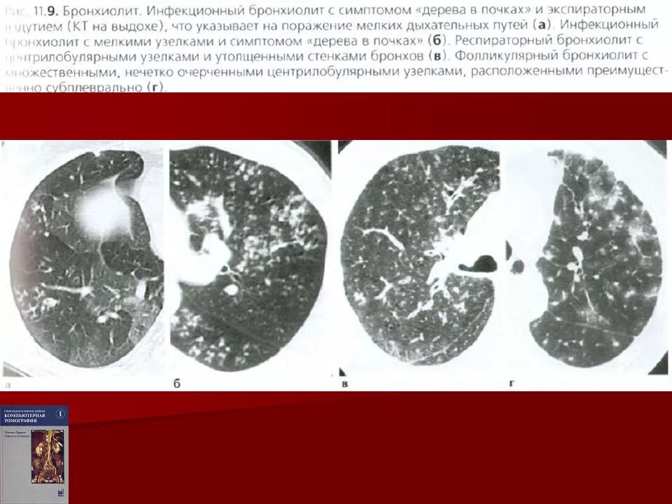 Дерева в почках в легких кт. Облитерирующего бронхиолита кт. Кт картина инфекционного бронхиолита. Респираторный бронхиолит кт картина. Бронхиолит кт дерево в почках.