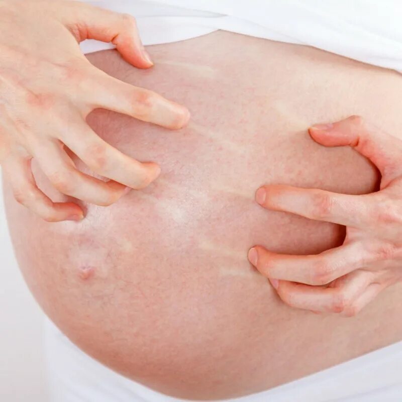 Сыпь на животе у беременных.